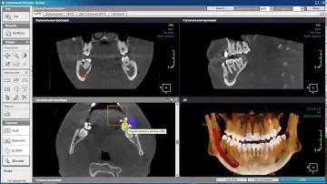 Обзор программы Ondemand3d Dental